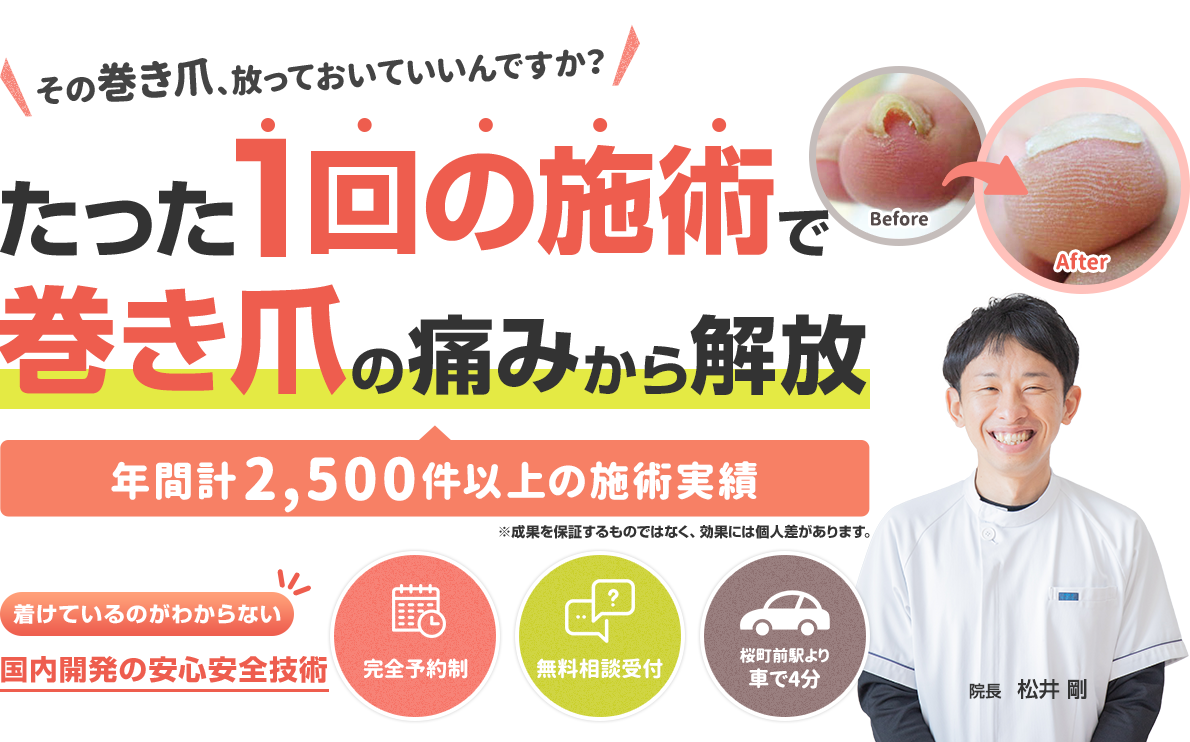たった1回の施術で巻き爪の痛みから解放
