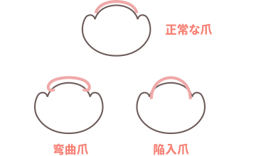 巻き爪