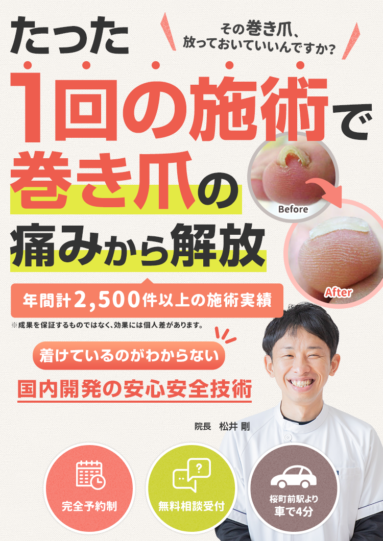 たった1回の施術で巻き爪の痛みから解放